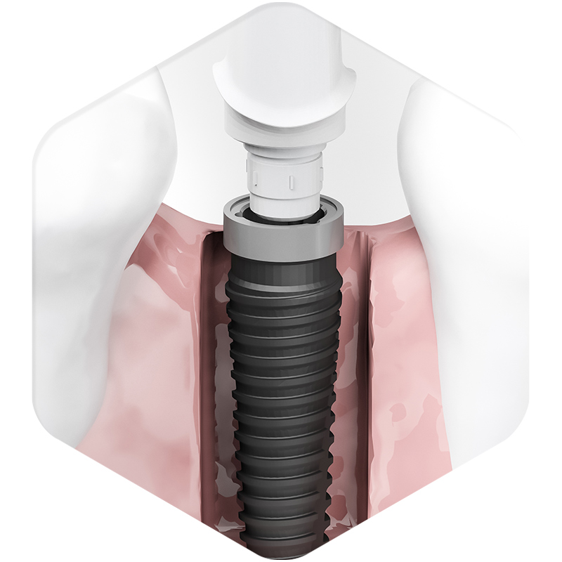 Implant Placement