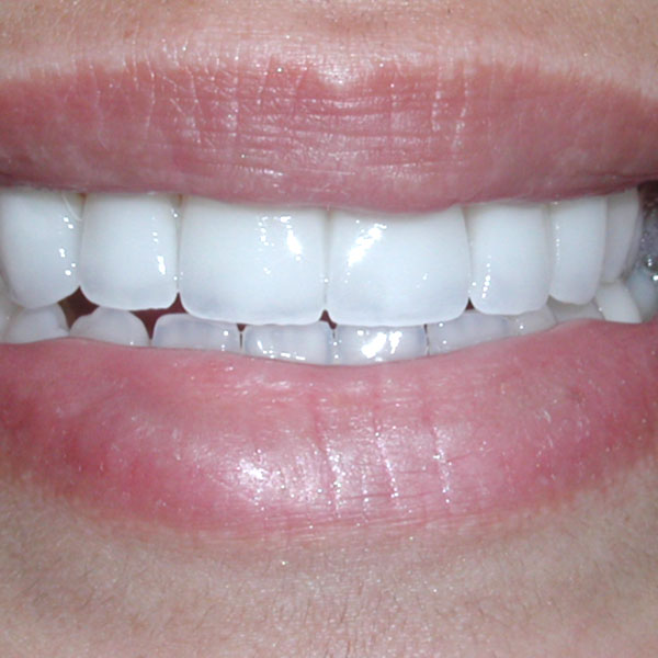 Whitening