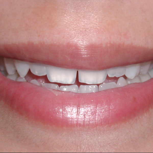 Whitening