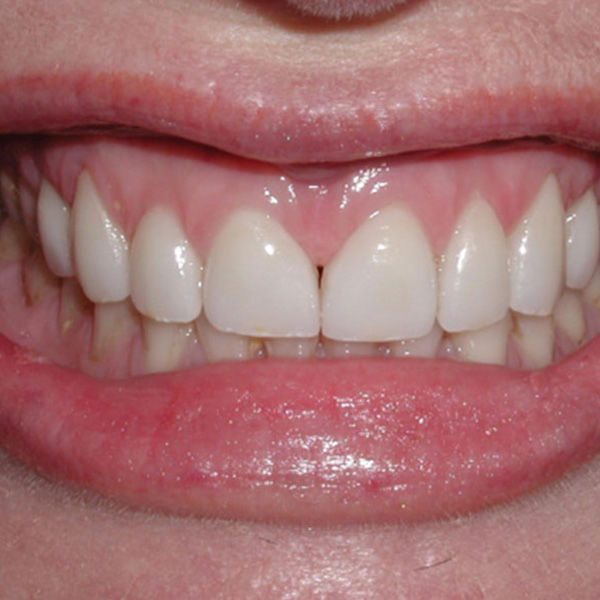 Veneers