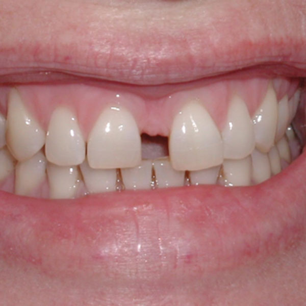 Veneers