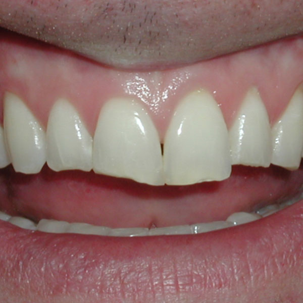Veneers