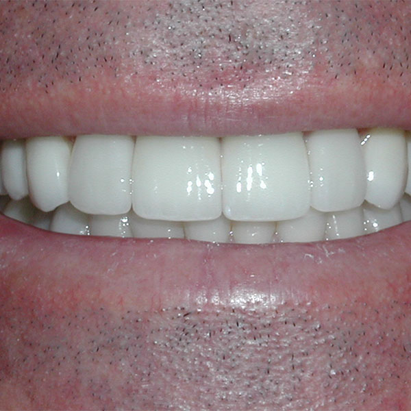 Whitening